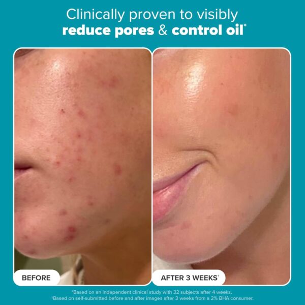 Paula's Choice SKIN PERFECTING 2% BHA Liquid Salicylic Acid Exfoliant-Facial Exfoliant for Blackheads, Enlarged Pores, Wrinkles & Fine Lines - Image 5
