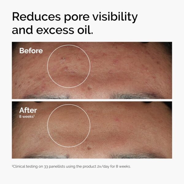 The Ordinary Niacinamide 10% + Zinc 1%, Smoothing Serum for Blemish-Prone Skin - Image 2
